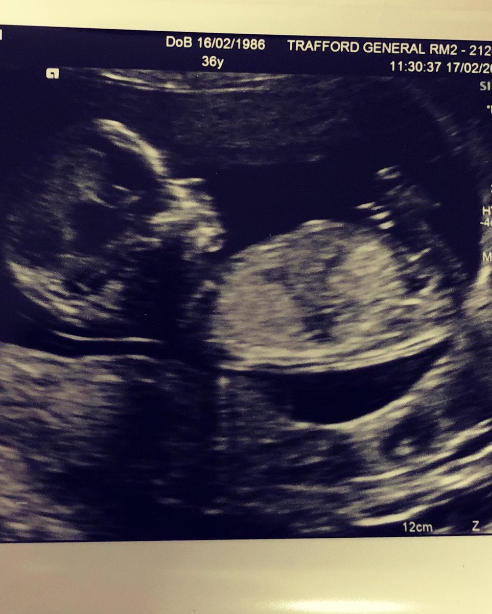 Steviedrabs's tweet photo. BABY NO.2 - DUE AUG 2022 ❤️❤️ https://t.co/vF67Rf5DX3