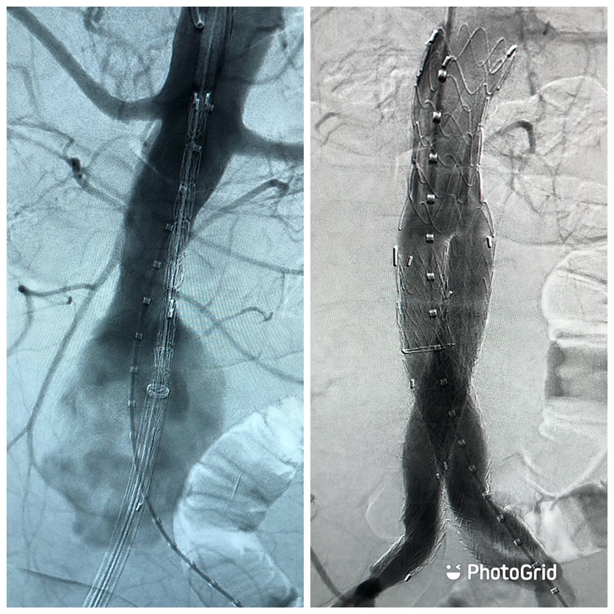 Disclaimer: this tweet is less about the excellent (#humble) #Gore Excluder Conformable Endoprosthesis and more about one of the most beautiful and inviting #aaa necks I’ve ever worked on. #CollaborativeVascularCare #aorta #aneurysm #irad <a href="/SIRspecialists/">Society of Interventional Radiology</a> <a href="/SIR_ECS/">SIR ECS</a> <a href="/SIRRFS/">SIR RFS</a>
