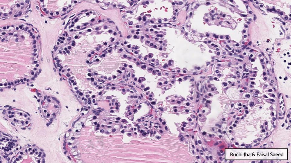 Georgia Association of Pathology (GAP) (@gapathologists) on Twitter photo GAP Case of the Month #7:
64♀️ w/ incidental 3.9 cm cystic renal mass.
By: Dr. Ruchi Jha & Dr. Faisal Saeed
🔬 Take a look for yourself (WSI, <a href="/pathpresenter/">pathpresenter.com</a>):
bit.ly/3Hb0VGF
💡 Answer & explanation:
bit.ly/3rVqHdf
#GAPCoTM #gupath GAP Case of the Month #7:
64♀️ w/ incidental 3.9 cm cystic renal mass.
By: Dr. Ruchi Jha & Dr. Faisal Saeed
🔬 Take a look for yourself (WSI, <a href="/pathpresenter/">pathpresenter.com</a>):
bit.ly/3Hb0VGF
💡 Answer & explanation:
bit.ly/3rVqHdf
#GAPCoTM #gupath