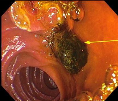 JamesHaddadMD's tweet photo. Native papilla 😎🔫💪

#ERCP #GITwitter #MedTwitter #choledocolithiasis https://t.co/Luc99VQwum