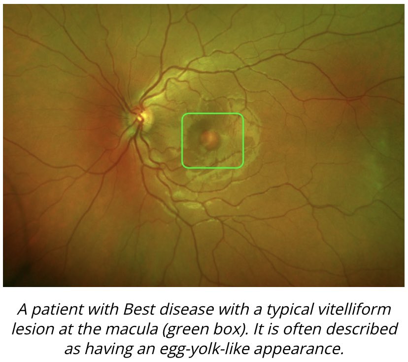 MariyaMoosajee's tweet photo. #BestDisease is a #RareDisease affecting the macula (central retina which helps us to see detail & colour). It affects 1 in 10,000 people, caused by genetic changes in #BEST1 gene leading to progressive sight loss. Read more: https://t.co/zQDJH7yqrz
#GeneVision @MacularSociety https://t.co/2F07jn7YFa