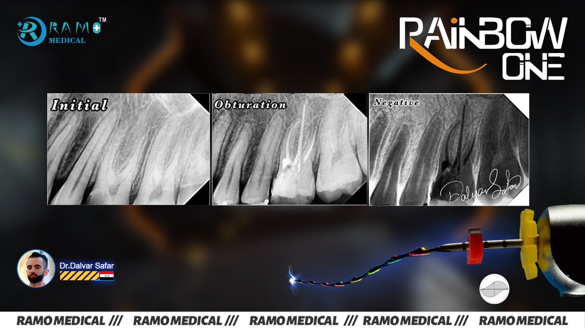 RamoMedical's tweet photo. ❤️Ramo Medical meets more and more dentist friends.Thank you 𝗗𝗿.𝗗𝗮𝗹𝘃𝗮𝗿 𝗦𝗮𝗳𝗮𝗿 for sharing the case.       
📌Rotary file :
𝗥𝗖𝗦 𝗥𝗮𝗶𝗻𝗯𝗼𝘄 𝗢𝗻𝗲 𝗙𝗶𝗹𝗲.🌈            #RamoMedical #RainbowOne #EndoFile #RotaryFile #FlexibleFile #Endodontic #Dentist #Endodontia https://t.co/h0k23yx8N2