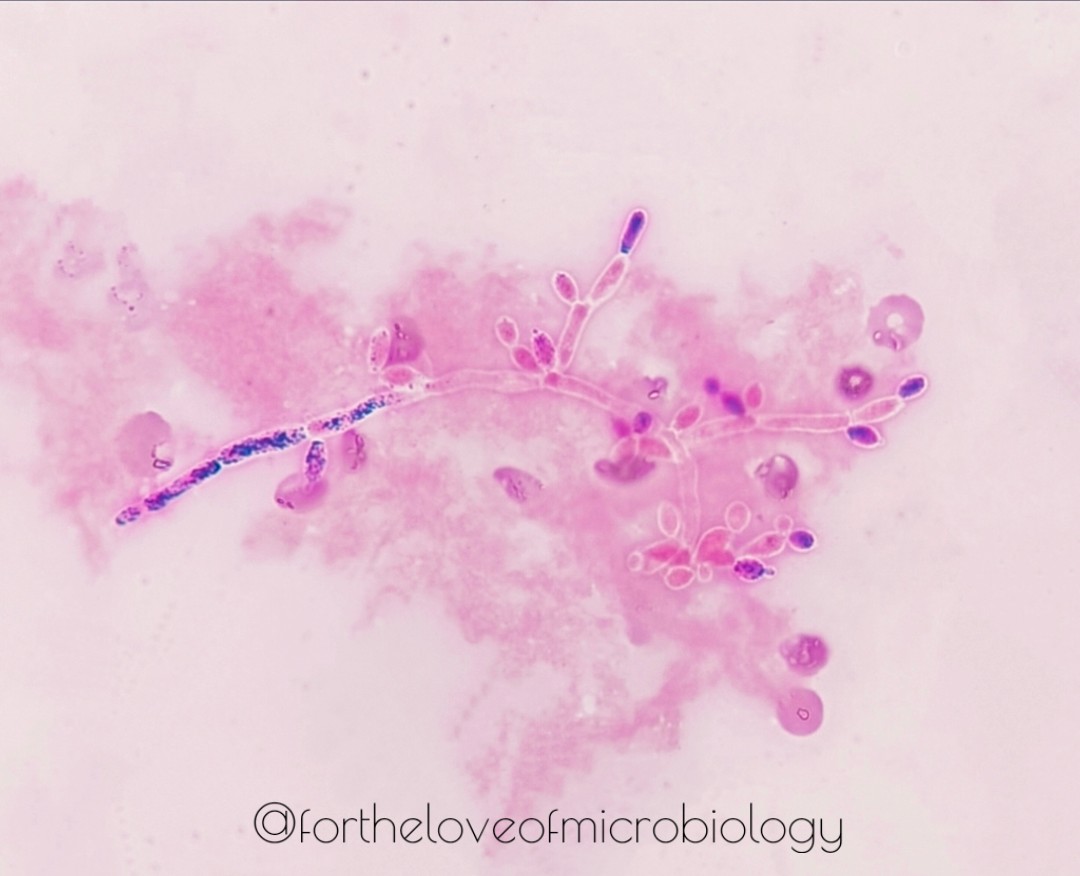 Random lab prettiness

Budding yeast cells with pseudohyphae formation seen on a gramstain from a positive blood culture bottle
#Fortheloveofmicrobiology #clinicalmicrobiology #mmidsp #microrounds #IDpath #ASMClinMicro