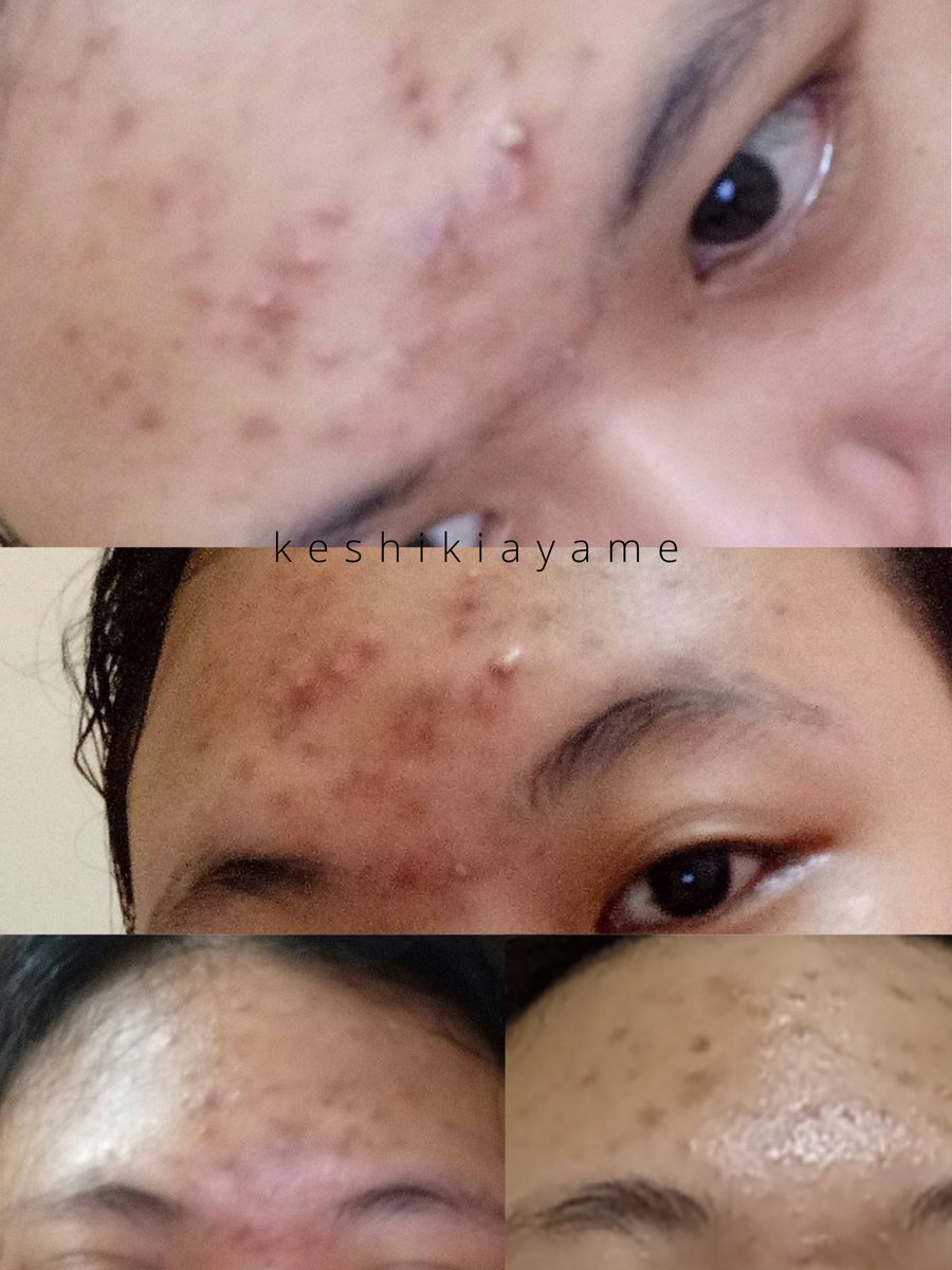 keshikiayame's tweet photo. How I cured my acne + products
— Cara aku nyembuhin jerawat

                      ✨A THREAD✨ https://t.co/3L5yGHavQT