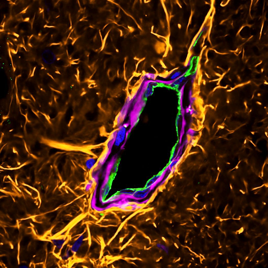 NicBechet's tweet photo. 100x confocal image deep in the hippocampus unveiling glymphatic micro-architecture ⛏️

Yellow: GFAP
Green: Lectin
Magenta: CSF tracer (in vivo circulation)

#FluorescenceFriday #sciart #science #art #neuroscience #astrocytes #imaging https://t.co/D0P6zlBIyj