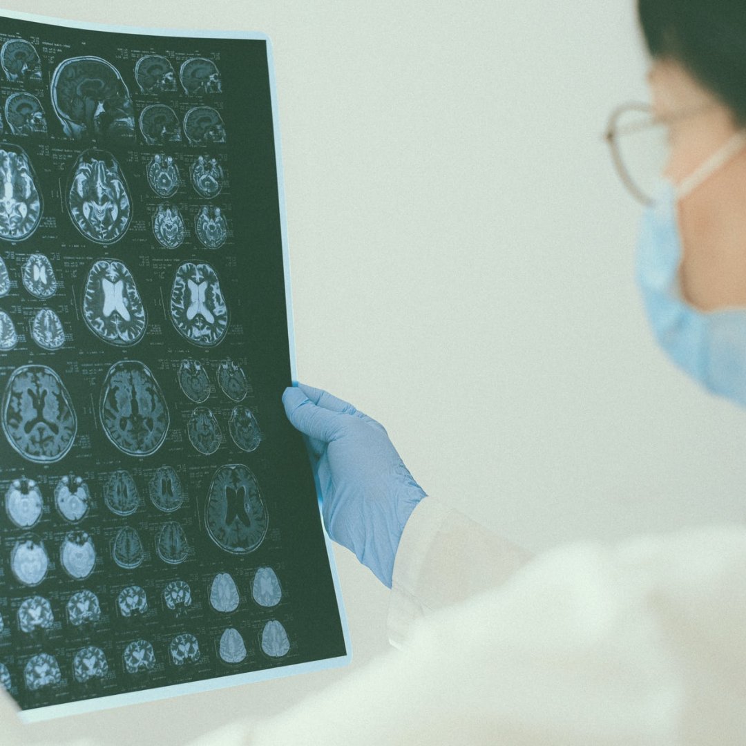 ThinkInsati's tweet photo. La neuroinflamación 🧠 contribuye a la neurodegeneración y consecuentemente a la progresión de la enfermedad de Parkinson. Por lo tanto, reducir esta inflamación se convierte en una vía terapéutica a estudiar 🙌🏽.
Fuente: @Fund_Parkinson
#tecnología #esalud #eHealth #IA #AVECEN https://t.co/whcPZmWw8q
