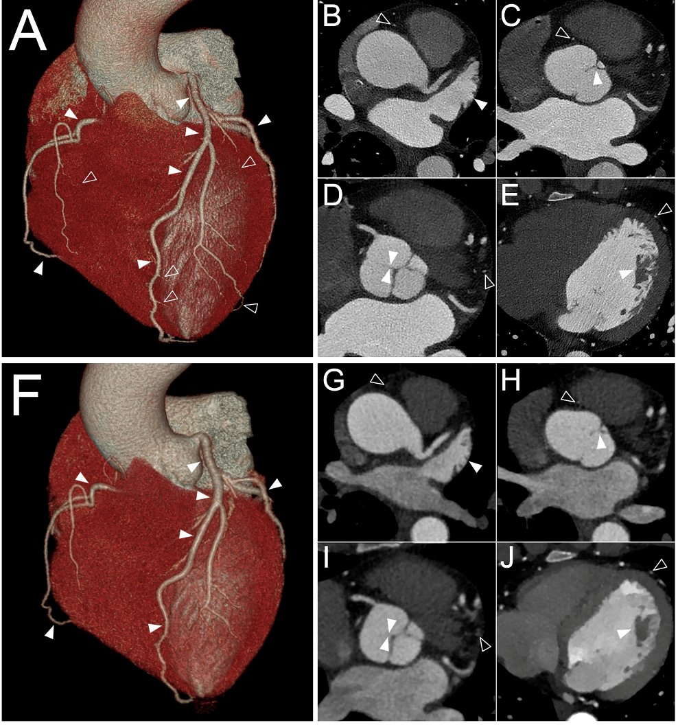 💡Imagerie médicale : du noir et blanc à la couleur ! Le Scanner Spectral à Comptage Photonique repousse les limites du scanner standard dans l'évaluation des pathologies cardiovasculaires et neuro-vasculaires ➡️bit.ly/3JzkGZW

#technologie #innovation #santé #presse