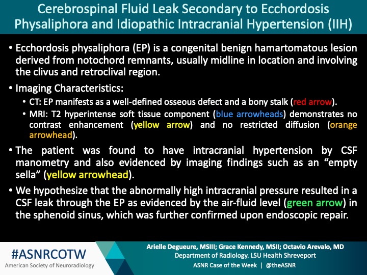 TheASNR's tweet photo. Great job everyone - this is a case of CSF leak secondary to Ecchordosis Physaliphora and idiopathic intracranial hypertension!

#neuro #Neurorad #radres #FOAMrad #medtwitter #ASNRCOTW @RadiologyLSU @Arielle1618 @gracekenn_ https://t.co/RWsd65F1ZP