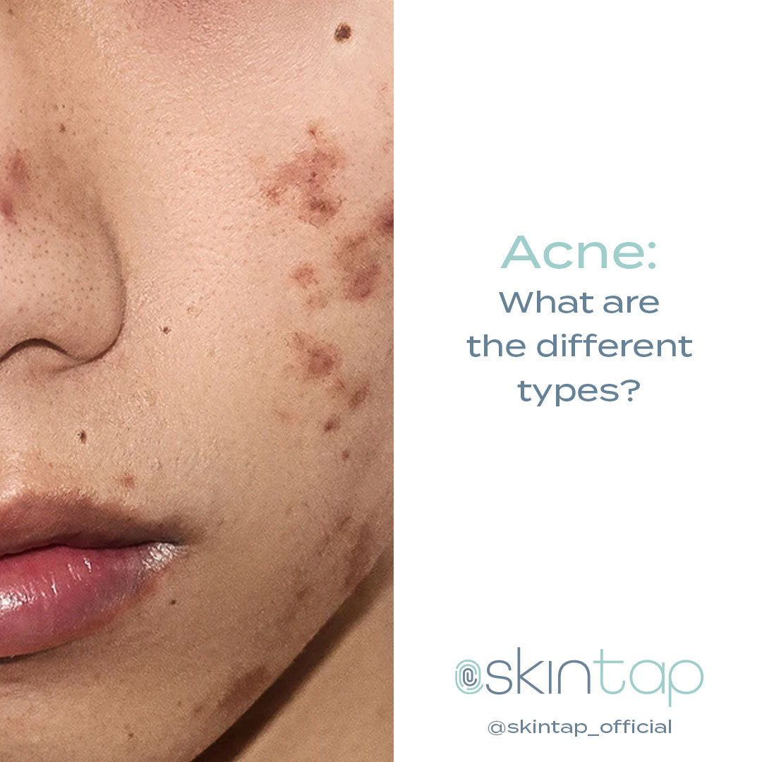 SkintapOfficial's tweet photo. Many people suffer from #acne, but did you know there are many types of acne?!

In our blog, we walk through the different kinds of acne &amp; what they look like!
#Skintap https://t.co/JrlnU9WFjB