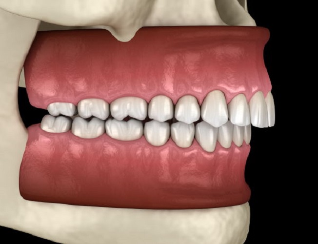 DentistryNews1's tweet photo. Overbite

https://t.co/xGTim2CPPZ

https://t.co/ik9qd3c97h https://t.co/kh2POogduT