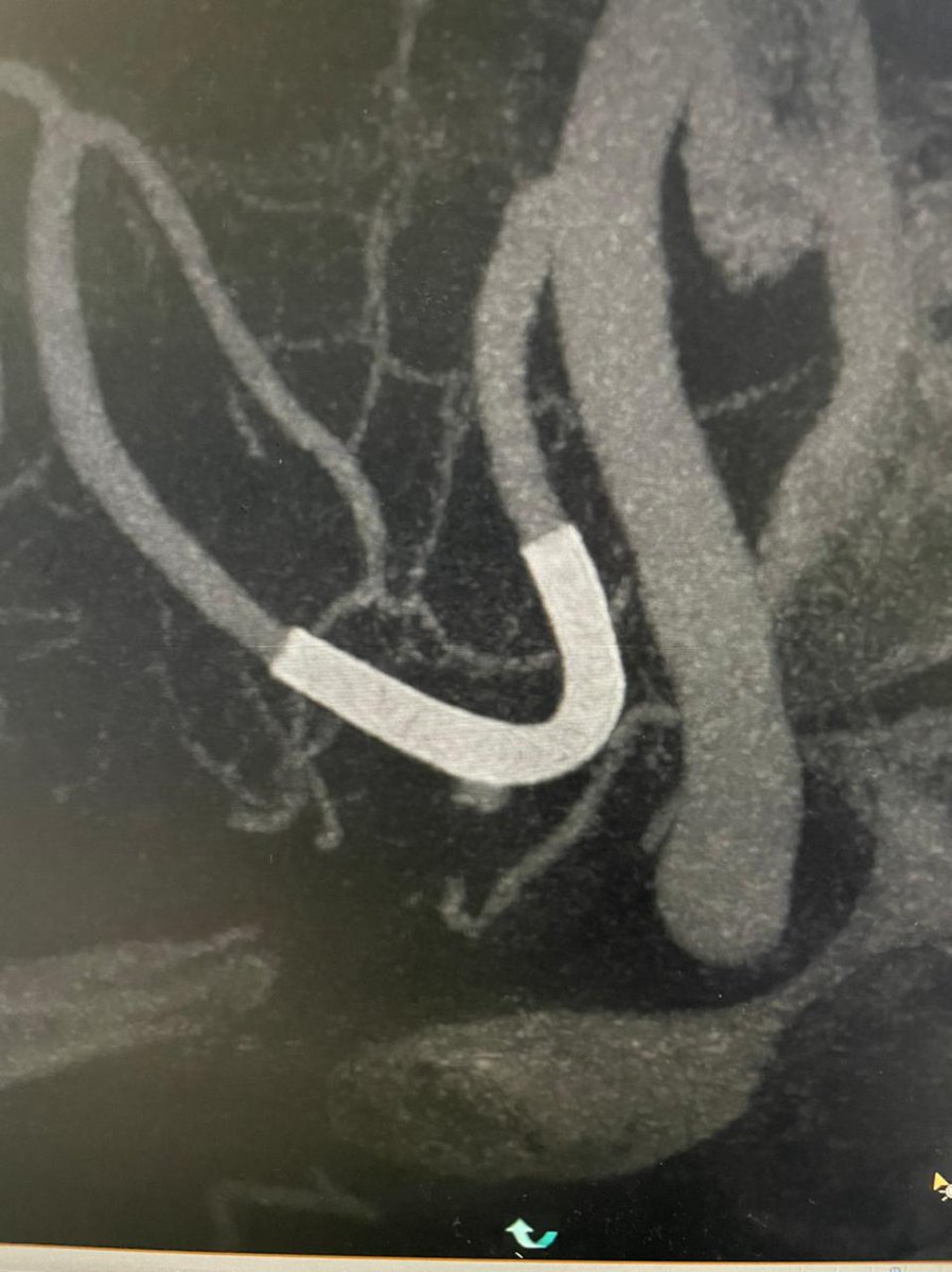 AgrimNeuro's tweet photo. Case of SAH due to dissecting distal aneurysm of left PICA. Due to challenging angles, we came through the right vertebral, retrogradely into the left PICA to place Silk Vista Baby flow diverter. https://t.co/3M5ptoeYTj