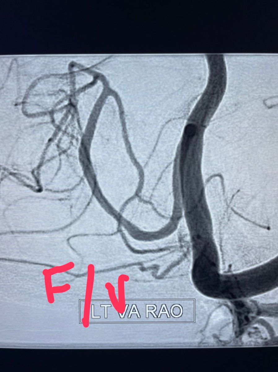 AgrimNeuro's tweet photo. Check angiogram showed complete reconstruction of the PICA with no stenosis.
@DrVipulGupta25 https://t.co/JBTbvjy5vM