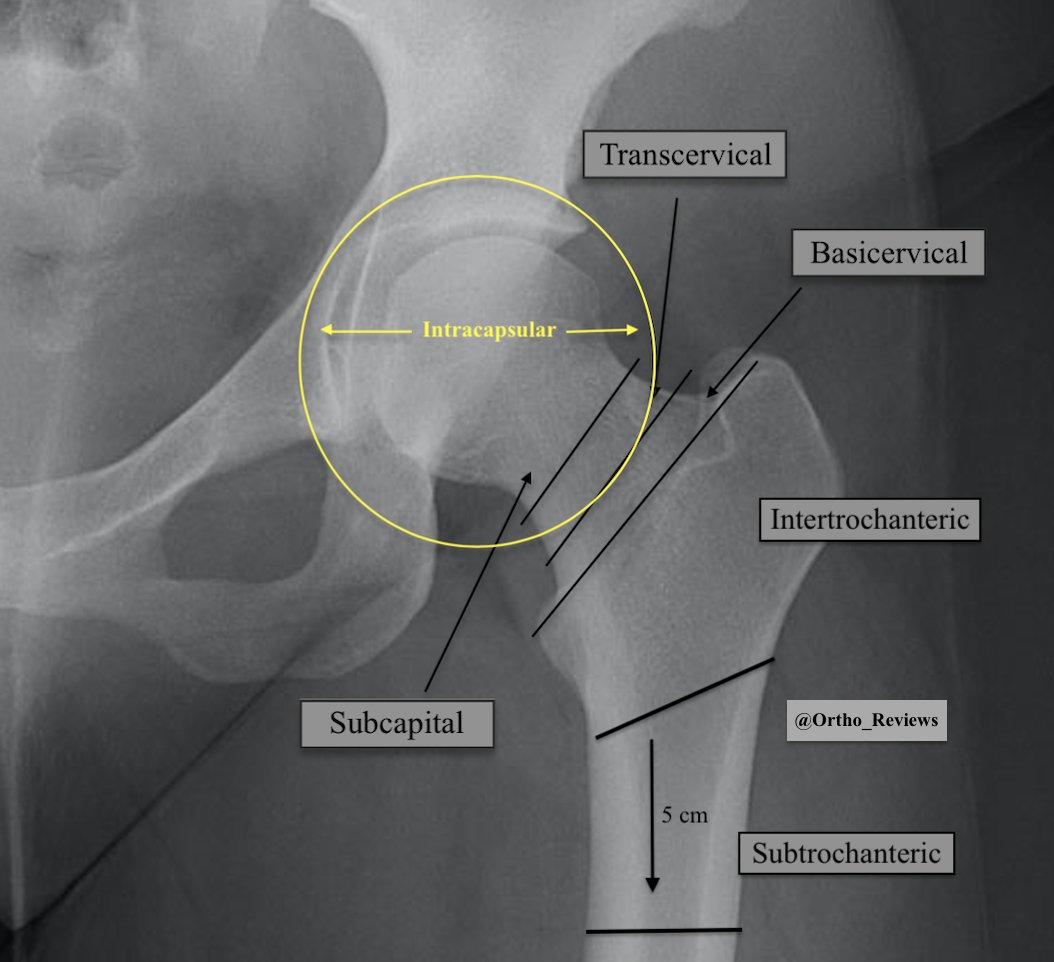 Intertrochanteric Fracture Vs Femoral Neck Fracture