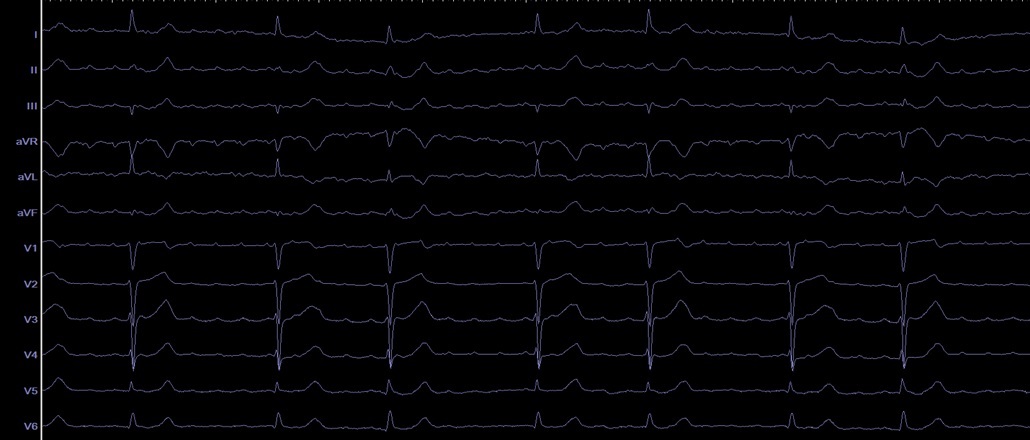Raquel_Adelino's tweet photo. Peri-mitral flutter ablation with PFA! Left flutter recurrence after previous AF ablation. Fragmented potentials and PPI-TCL +10ms at the mitral isthmus: 1 PFA application at the mitral isthmus terminates the flutter.
@SergeBoveda  @farapulse @BSCCardiology 
#EPeeps https://t.co/eI7AEaMwPv