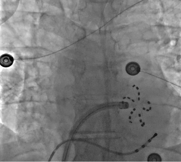Raquel_Adelino's tweet photo. Peri-mitral flutter ablation with PFA! Left flutter recurrence after previous AF ablation. Fragmented potentials and PPI-TCL +10ms at the mitral isthmus: 1 PFA application at the mitral isthmus terminates the flutter.
@SergeBoveda  @farapulse @BSCCardiology 
#EPeeps https://t.co/eI7AEaMwPv