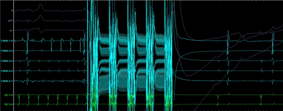 Raquel_Adelino's tweet photo. Peri-mitral flutter ablation with PFA! Left flutter recurrence after previous AF ablation. Fragmented potentials and PPI-TCL +10ms at the mitral isthmus: 1 PFA application at the mitral isthmus terminates the flutter.
@SergeBoveda  @farapulse @BSCCardiology 
#EPeeps https://t.co/eI7AEaMwPv