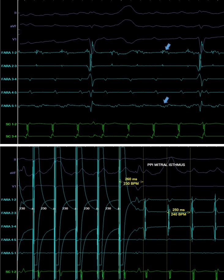 Raquel_Adelino's tweet photo. Peri-mitral flutter ablation with PFA! Left flutter recurrence after previous AF ablation. Fragmented potentials and PPI-TCL +10ms at the mitral isthmus: 1 PFA application at the mitral isthmus terminates the flutter.
@SergeBoveda  @farapulse @BSCCardiology 
#EPeeps https://t.co/eI7AEaMwPv