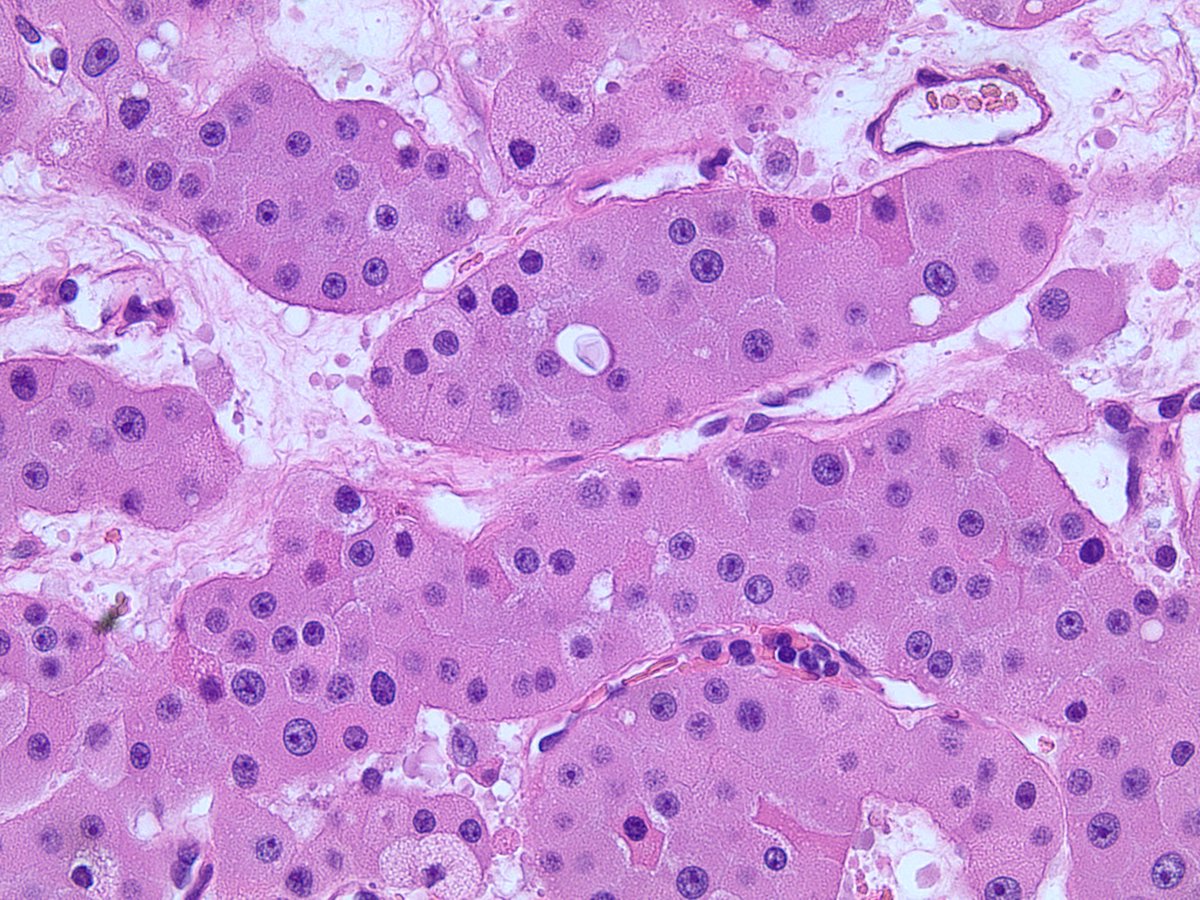 MCG Urology (@mcg_urology) on Twitter photo Frustrated by the inability to distinguish between oncocytoma and oncocytic renal cell carcinoma? Check out our collaboration in Cells. 2022 Jan 15;11(2):287 pubmed.ncbi.nlm.nih.gov/35053403/ @mkterris <a href="/nmsavage_path/">Natasha M. Savage</a> Frustrated by the inability to distinguish between oncocytoma and oncocytic renal cell carcinoma? Check out our collaboration in Cells. 2022 Jan 15;11(2):287 pubmed.ncbi.nlm.nih.gov/35053403/ @mkterris <a href="/nmsavage_path/">Natasha M. Savage</a>