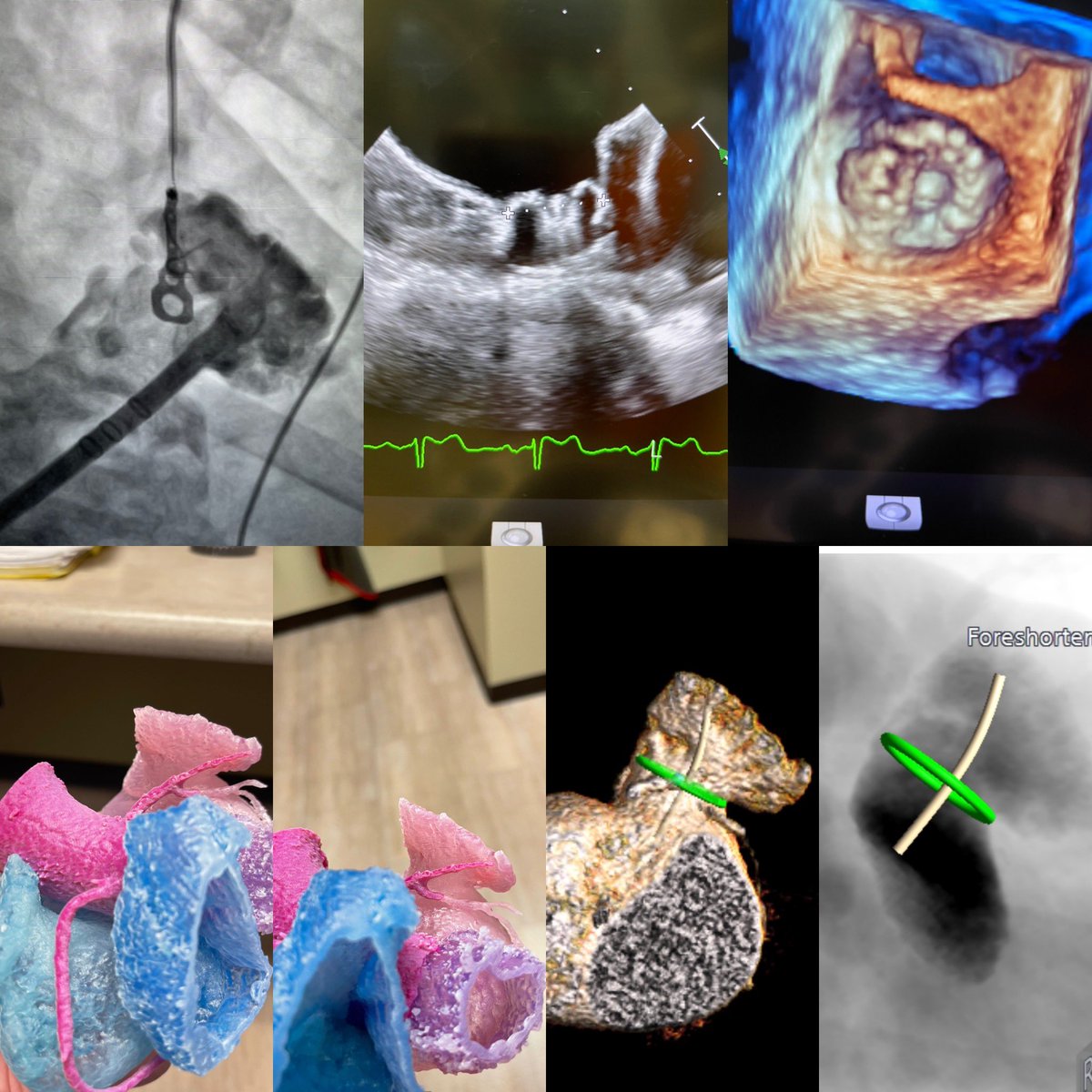 Dr.<a href="/khuberf1/">Ken Huber</a> of St. Lukes Hospital of Kansas City, Mo used #TruPlan, 3D printing and #watchmanflx to safely close this left atrial appendage. The Safety, Simplicity and Seal of the Watchmanflx device reducing the risk of stroke and saying #byebyebloodthinner.