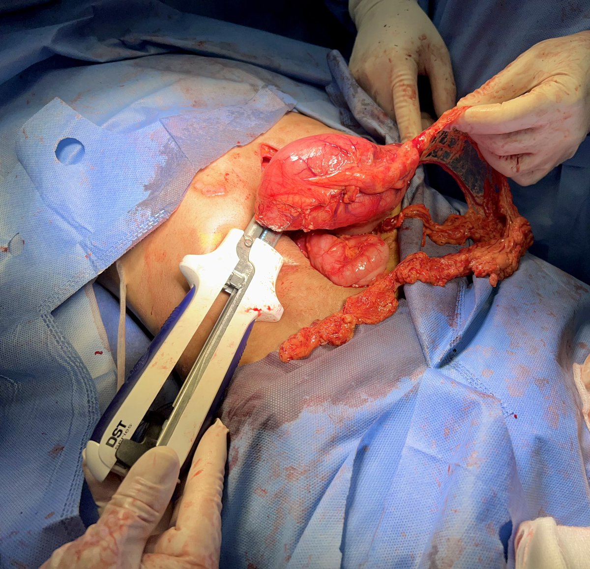 OmarChungata's tweet photo. Paciente femenina de 32 años de edad, se le realizó Gastrectomía Total + esofagoyeyunoanastomosis en Y de Roux por Adenocarcinoma Gástrico
#adenocarcinomagástrico 
#tumordeestomago
#cirugiadigestiva
#gastrectomiatotal
#gastrectomia
#cirugiadigestivaavanzaba 
#cirujanodigestivo https://t.co/gkBjHNKrDH