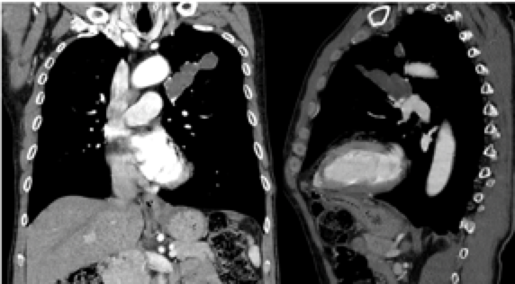 RadiologyCored's tweet photo. Bronchial atresia is a developmental anomaly. The most common location is the apicoposterior left upper lobe. Differential includes allergic bronchopulmonary aspergillosis (ABPA) given the finger-in-glove appearance. #radiology #radcases https://t.co/GyJK5qqmcC
