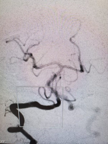 PenNeuro's tweet image. US HCPs: #RED62 used in #PosteriorOcclusion case by Dr. Miguel L. Litao out of @SaintClares. #REDGlideDifference Rx only. For risk info: bit.ly/37YcYIU. Clinical results may vary.