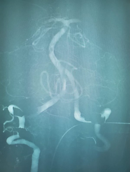 PenNeuro's tweet image. US HCPs: #RED62 used in #PosteriorOcclusion case by Dr. Miguel L. Litao out of @SaintClares. #REDGlideDifference Rx only. For risk info: bit.ly/37YcYIU. Clinical results may vary.