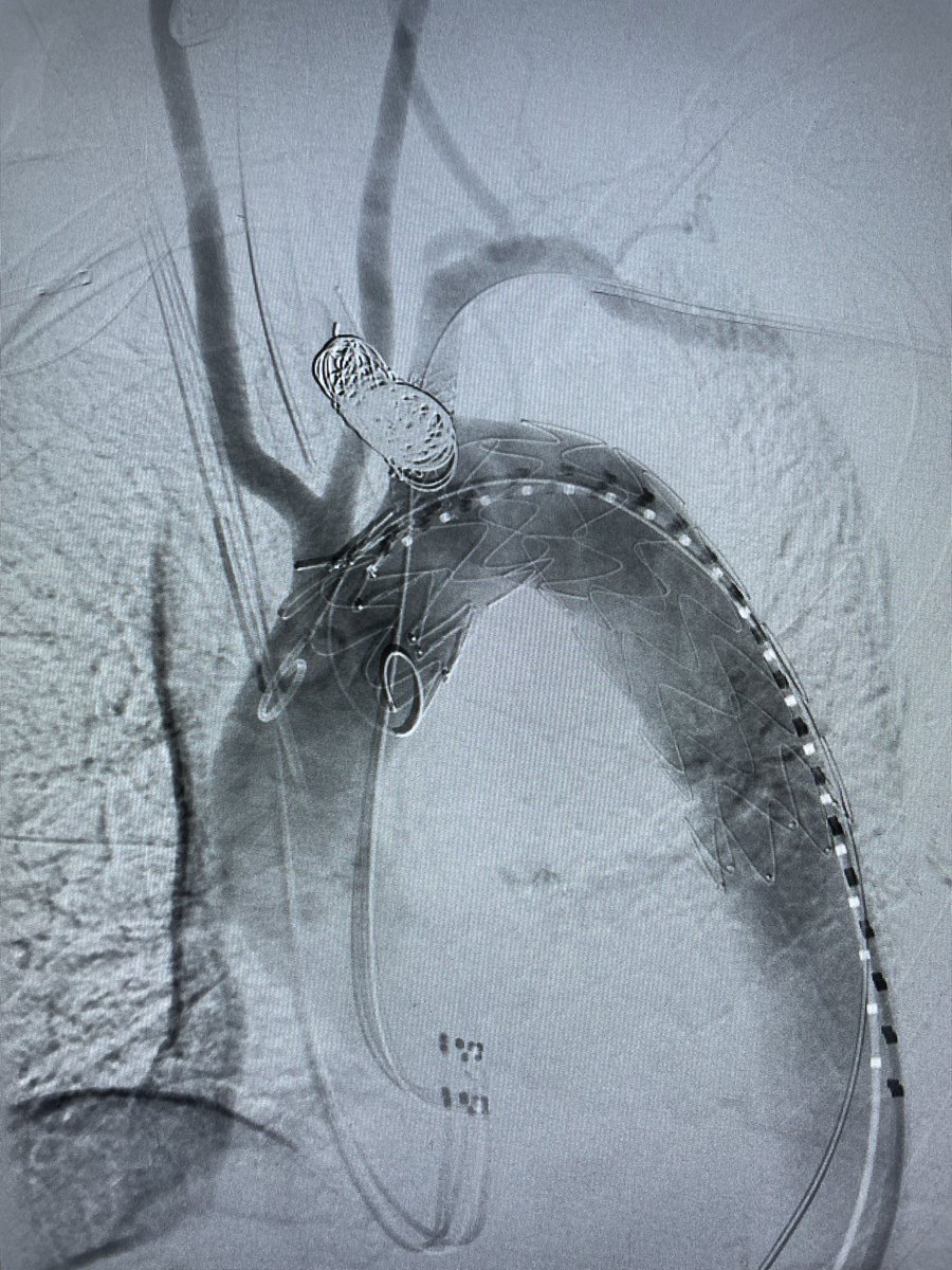 DanielMilesMD (@danielmilesmd) on Twitter photo ~80M arriving overnight w aberrant R subclavian and #rupture of Kommerell’s diverticulum - tx with some compressions and #TEVAR, laser #fenstration LSA and embolized aberrant R. #VascSurg #VascularTwitter #Aorta #AortaEd <a href="/VSA_LLC/">Vascular Surgery Associates</a> <a href="/MoridzadehMD/">Rameen S. Moridzadeh, MD</a> <a href="/VascularSurgCS/">Cedars-Sinai Division of Vascular Surgery</a> <a href="/DeptSurgeryCS/">Department of Surgery at Cedars-Sinai</a> ~80M arriving overnight w aberrant R subclavian and #rupture of Kommerell’s diverticulum - tx with some compressions and #TEVAR, laser #fenstration LSA and embolized aberrant R. #VascSurg #VascularTwitter #Aorta #AortaEd <a href="/VSA_LLC/">Vascular Surgery Associates</a> <a href="/MoridzadehMD/">Rameen S. Moridzadeh, MD</a> <a href="/VascularSurgCS/">Cedars-Sinai Division of Vascular Surgery</a> <a href="/DeptSurgeryCS/">Department of Surgery at Cedars-Sinai</a>