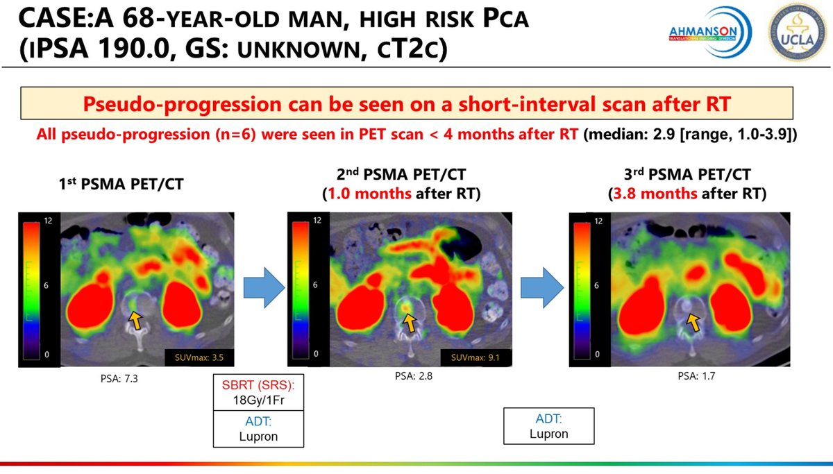 DrMHofman's tweet photo. Kinetics of PSMA uptake on PET post external beam radiotherapy: super interesting data from #MasatoshiHotta @CalaisJeremie @ASCO #GU22. Lesion uptake decreases gradually and reaches lowest at 9-12 months. Prostate response slower than bone or LN.
Any thoughts @_ShankarSiva ? https://t.co/GJJQNhrfCr