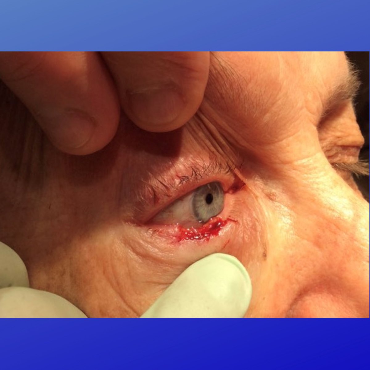 MohsCollege's tweet photo. #FlapFriday- This patient had a nodular BCC of the right lower eyelid margin which required two stages of excision to clear. With enough laxity, defects can be repaired with a wedge repair, carefully reapproximating the margin.
Photo Credit: Mark F. Baucom, MD, FACMS https://t.co/y1Qpip6AwG