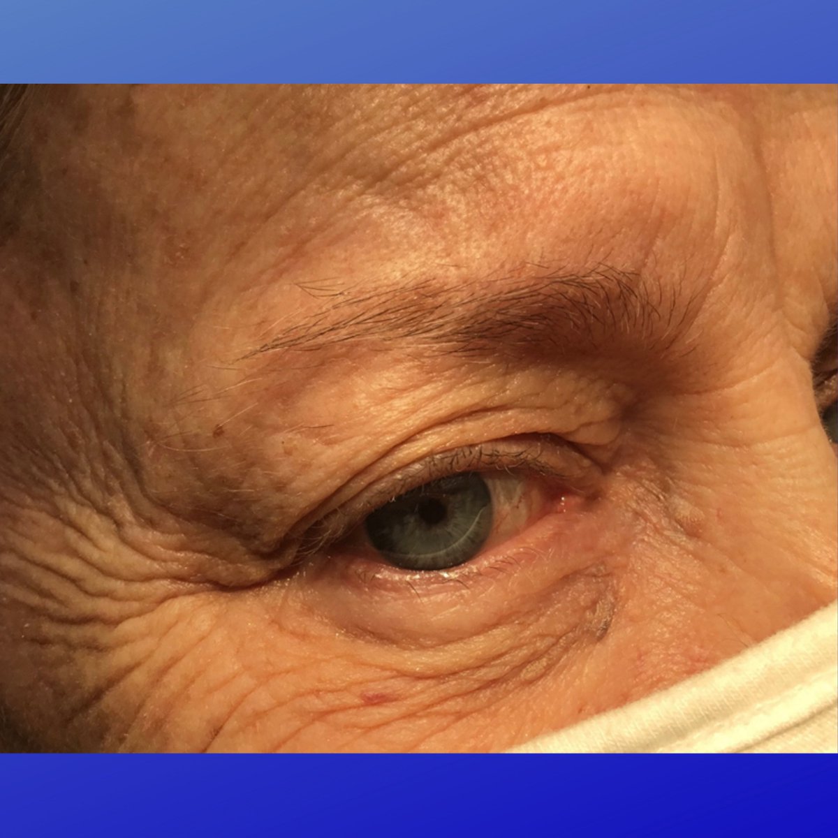 MohsCollege's tweet photo. #FlapFriday- This patient had a nodular BCC of the right lower eyelid margin which required two stages of excision to clear. With enough laxity, defects can be repaired with a wedge repair, carefully reapproximating the margin.
Photo Credit: Mark F. Baucom, MD, FACMS https://t.co/y1Qpip6AwG