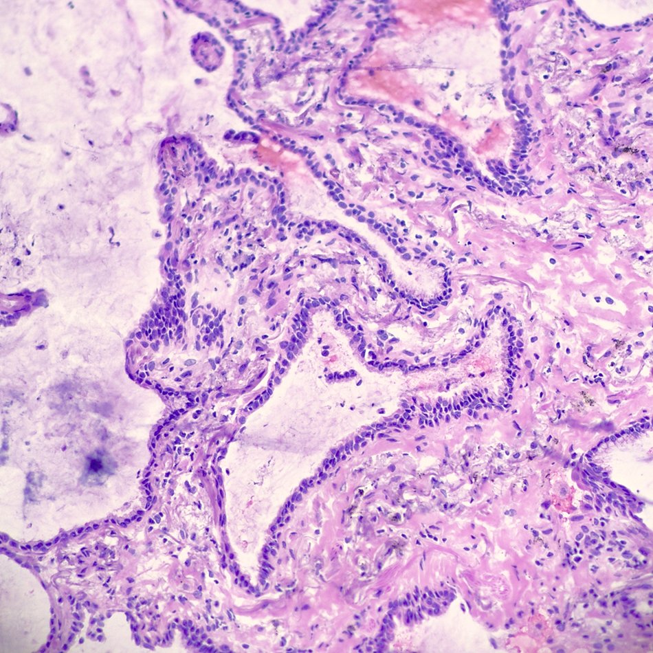 ♀️ 80-year-old female 
🚬55 pack-year smoking history
🦀Recent T3 colon cancer
🧊Frozen section: 2.0cm RLL lung lesion