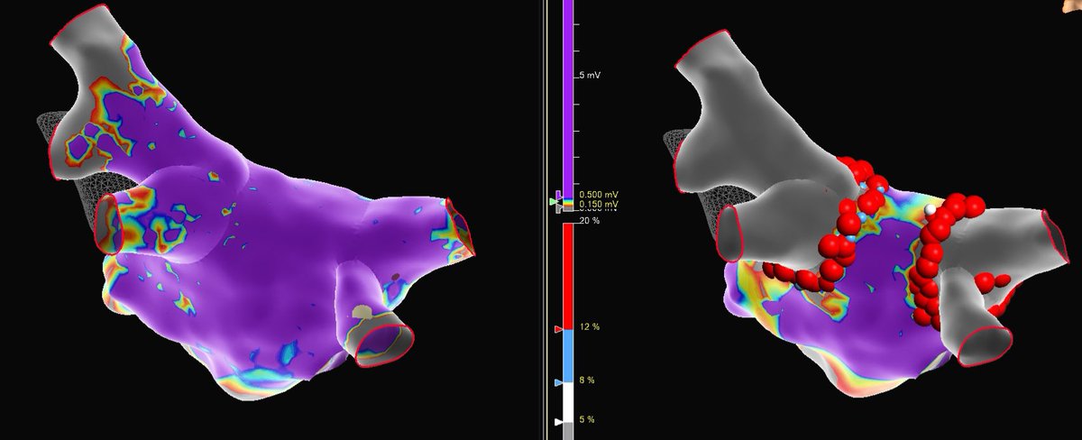 HISrefrPVC's tweet photo. Voxel mode on Ensite X!! First pass on right, slight roof touch up left using OT. Thanks to @eggheded - amazing mapper! #EnsiteX #AbbottEP #EPeeps https://t.co/jr31ac0CN5