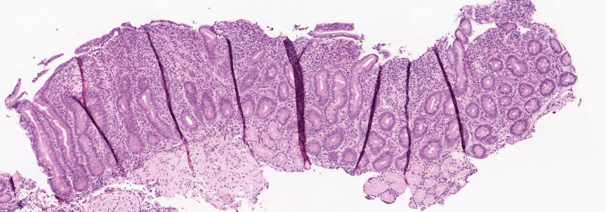 KevanSalimian's tweet photo. Chronic diarrhea. Duodenal Biopsy. Villous Blunting. Intraepithelial lymphocytosis. Expanded lamina propria. Classic case of celiac disease? Not this time! Celiac labs negative. The diagnosis (in comments) is obvious after review of chart. #GIPath #MedEd #PathTwitter #GITwitter https://t.co/RKxa6EDZ6F
