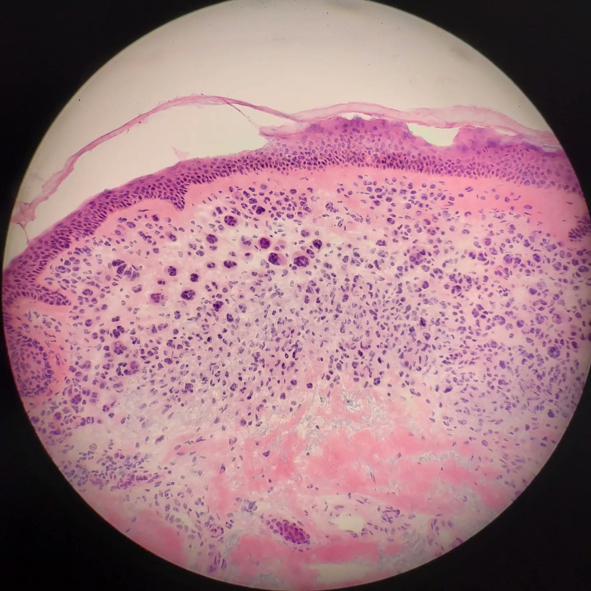 drvitalyt's tweet photo. Mohs surgery frozen section of the day - Intradermal nevus. 

This benign lesion was found incidentally during Mohs surgery for a basal cell carcinoma. 

The multinucleaned melanocytes may look abnormal but they are benign. https://t.co/hOgjac7sZq
