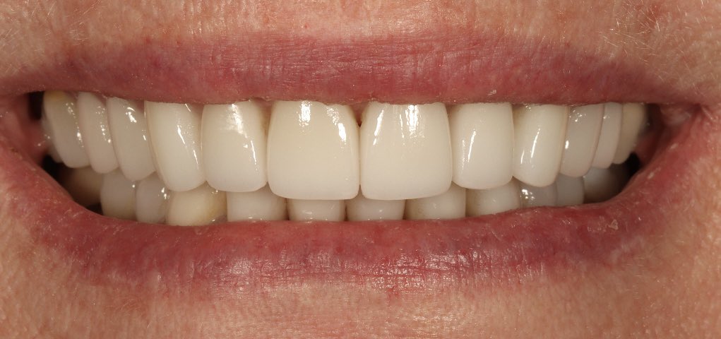 treyhmiller's tweet photo. For this smile makeover project, I decided to use 10 veneers to idealize the tooth proportions and smile curve. Nice, natural enhancement procedure. #cosmeticdentistry https://t.co/KTp9ut6svS