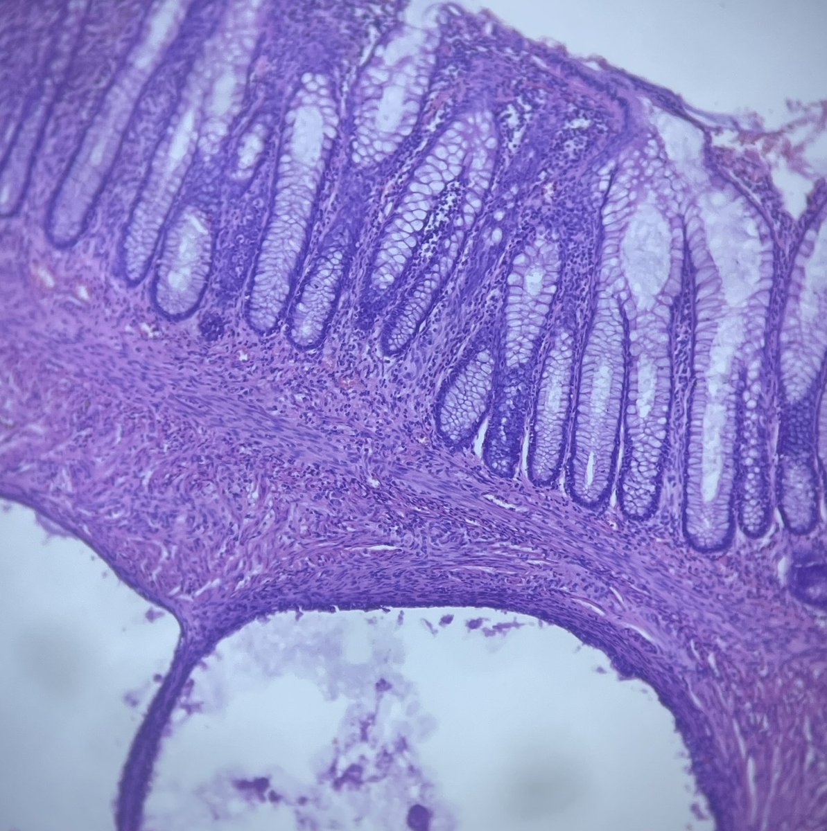 nadpath's tweet photo. Colon endometriosis #GIpath #gupath https://t.co/gfmXjsLwdz
