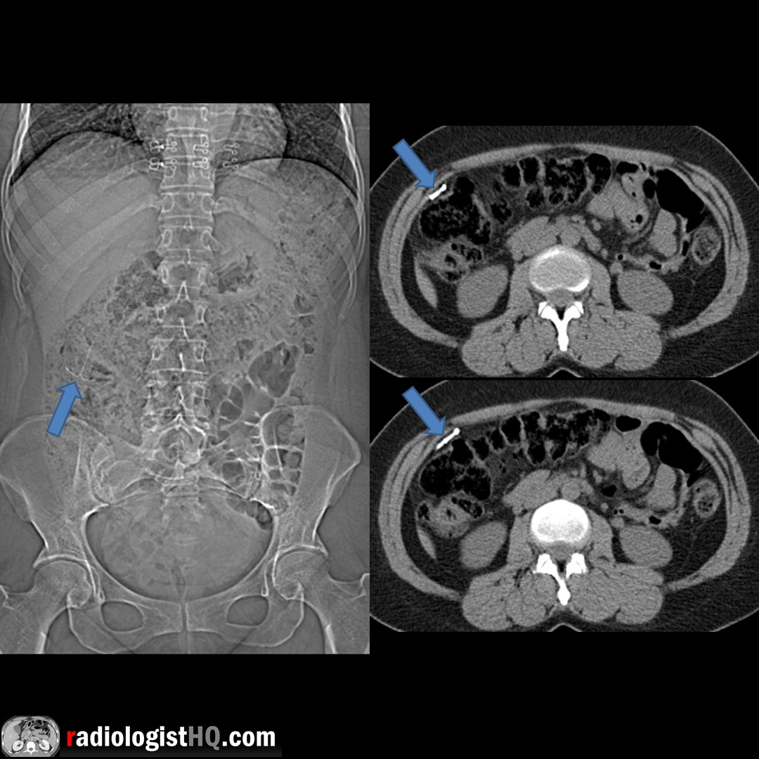 IUD migration into abdomen. Scout view &amp; CT shows IUD in right abdomen anterior to colon. Required laparoscopic surgical removal. IUD above pelvic brim or far lateral on frontal x-ray = Highly suggestive of extrauterine location.

#FOAMrad #FOAMed #radres #radtech #medstudent