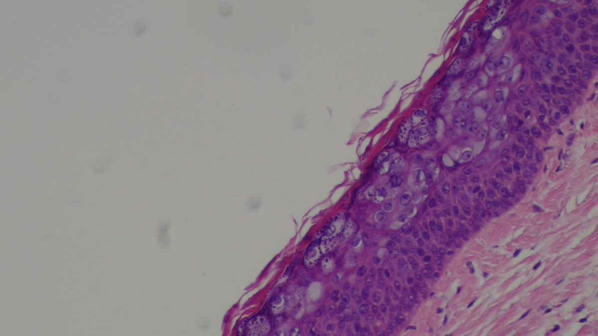 QassidO's tweet photo. epidermodysplasia verruciformis (EV Acanthoma) #skinPathology #dermatology #dermpath @JMGardnerMD #PathTwitter https://t.co/LLQlg6jaYe