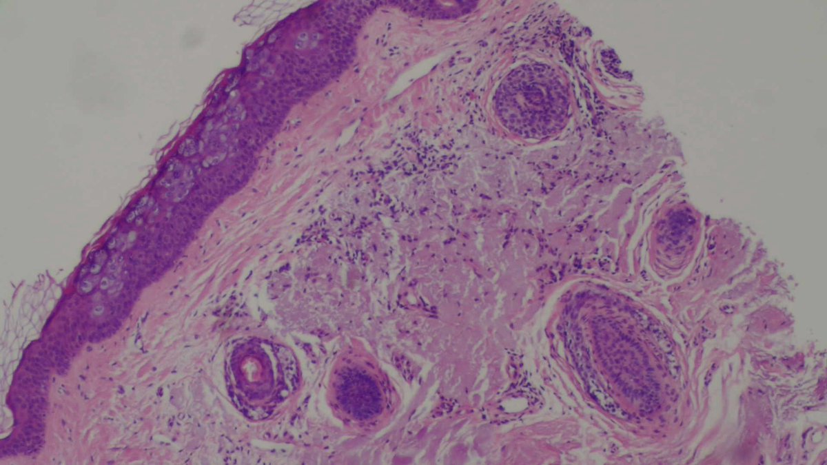 QassidO's tweet photo. epidermodysplasia verruciformis (EV Acanthoma) #skinPathology #dermatology #dermpath @JMGardnerMD #PathTwitter https://t.co/LLQlg6jaYe