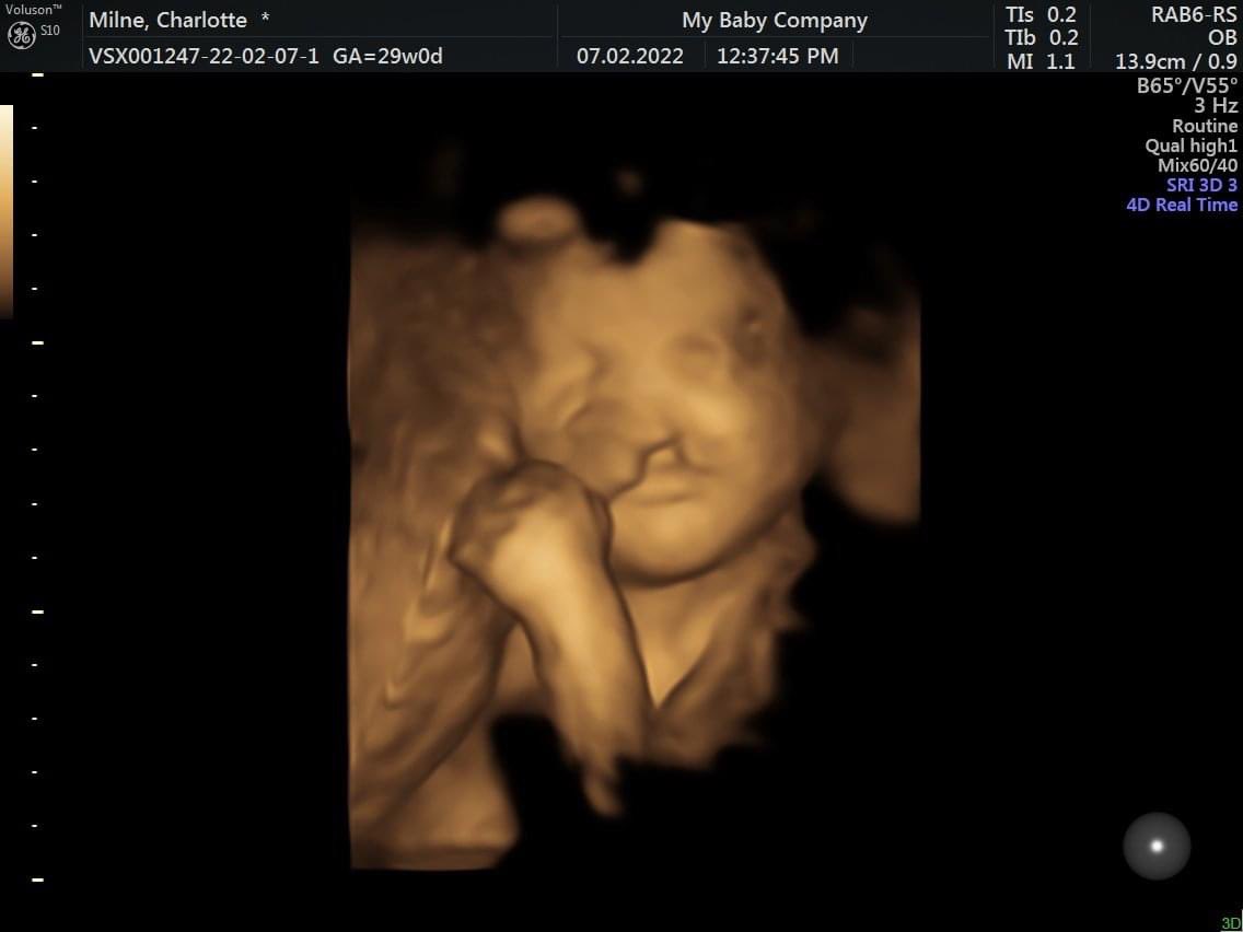 Charlotte170205's tweet photo. Had our 4D scan to see our beautiful baby girls face 🥰 it was nice to have that glimpse and knowing more what to expect for when she is born ♥️ she is so perfect to us and we can’t wait to meet her and hold her in April 🥰 @CLAPACOMMUNITY #Cleft #Cleftlip #CLAPA #4Dscan #baby https://t.co/GjmaqiXAvJ