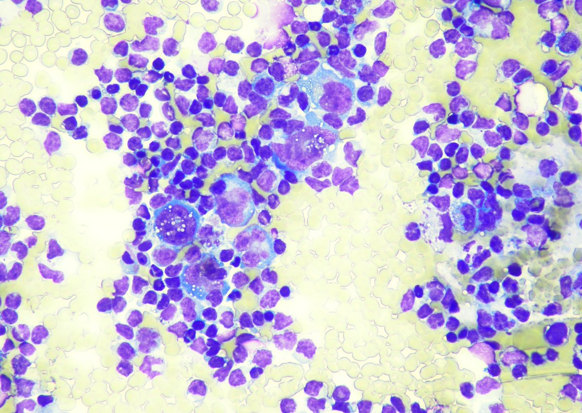 9Nr1KCDfUhG9RYO's tweet photo. Follow-up of the case. 35 yo, f, breast implant since 2014. Cytology. Cell-block, IHC. CD 30+(ALK-)
Surgery was performed. Capsule sample CD30+ 
@pepeheffernan @glinglerimek @elsa_borisova @ElmiraKomissar6 @fcschmitt @CancerCytopath @nucleololailo  https://t.co/0x7MRbqRZD https://t.co/YyRj1dRLXW