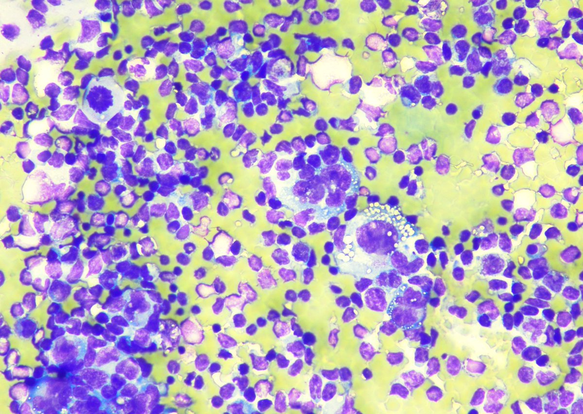 9Nr1KCDfUhG9RYO's tweet photo. Follow-up of the case. 35 yo, f, breast implant since 2014. Cytology. Cell-block, IHC. CD 30+(ALK-)
Surgery was performed. Capsule sample CD30+ 
@pepeheffernan @glinglerimek @elsa_borisova @ElmiraKomissar6 @fcschmitt @CancerCytopath @nucleololailo  https://t.co/0x7MRbqRZD https://t.co/YyRj1dRLXW
