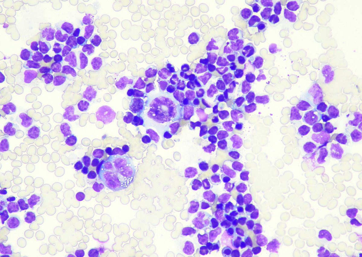 9Nr1KCDfUhG9RYO's tweet photo. Follow-up of the case. 35 yo, f, breast implant since 2014. Cytology. Cell-block, IHC. CD 30+(ALK-)
Surgery was performed. Capsule sample CD30+ 
@pepeheffernan @glinglerimek @elsa_borisova @ElmiraKomissar6 @fcschmitt @CancerCytopath @nucleololailo  https://t.co/0x7MRbqRZD https://t.co/YyRj1dRLXW