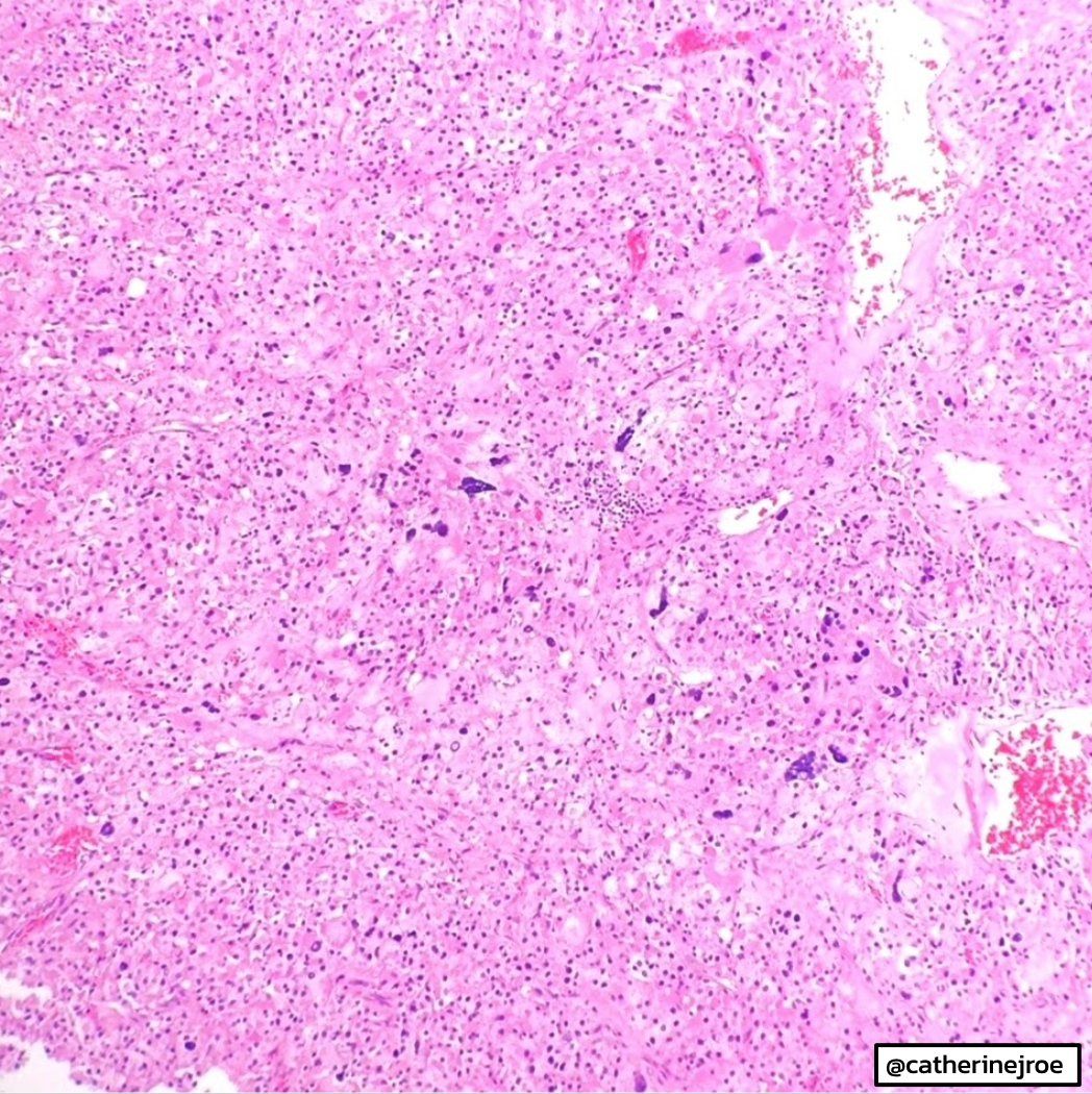 EmoryPathology's tweet photo. REPOST of Emory Case of the Week #17
.
54 y/o female presents with 12 cm adrenal mass. Radical nephrectomy performed.

Answer the question below!

Contributor: @catherinejroe

#EmoryCoTW #gupath #endopath https://t.co/1ddy1qyPF2