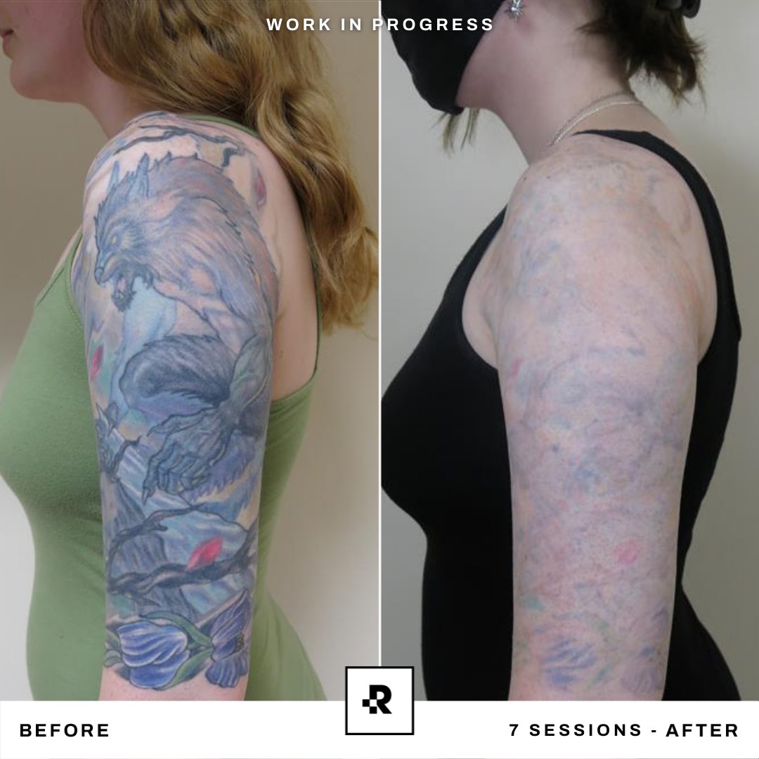 Types of Tattoos That Can Be Remove with Laser Tattoo Removal