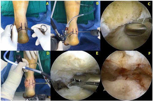 AOFAS_Journals's tweet photo. Subtalar arthritis may be treated w/ arthrodesis through open approach or posterior subtalar arthroscopy. Both techniques yielded significant improvement in pain &amp; function, yet arthroscopic technique was better at shortening the union &amp; recovery times: https://t.co/wzDkNjyEMP https://t.co/Y1z7PtVYw3