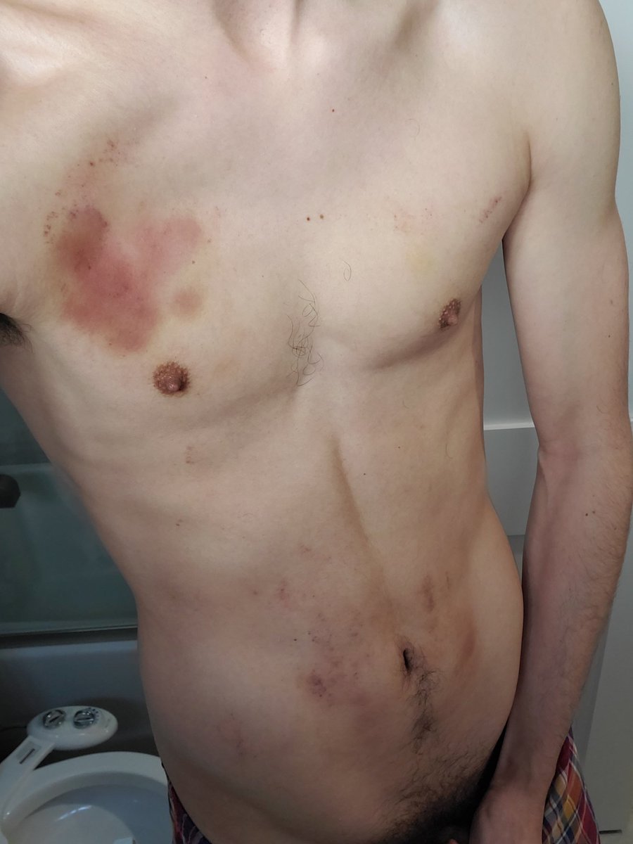 MildlyLimitless's tweet photo. I love looking at my bruises the next morning 😁
#bdsmboy #gay #roughsex #biting https://t.co/018h6FWdzi
