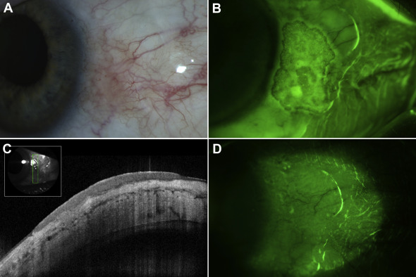 AAOjournal's tweet photo. Visualization of ocular surface squamous neoplasia with a yellow barrier filter over cobalt blue light after instillation of fluorescein. https://t.co/0jfiv8fIIG https://t.co/TKuFve2T7g