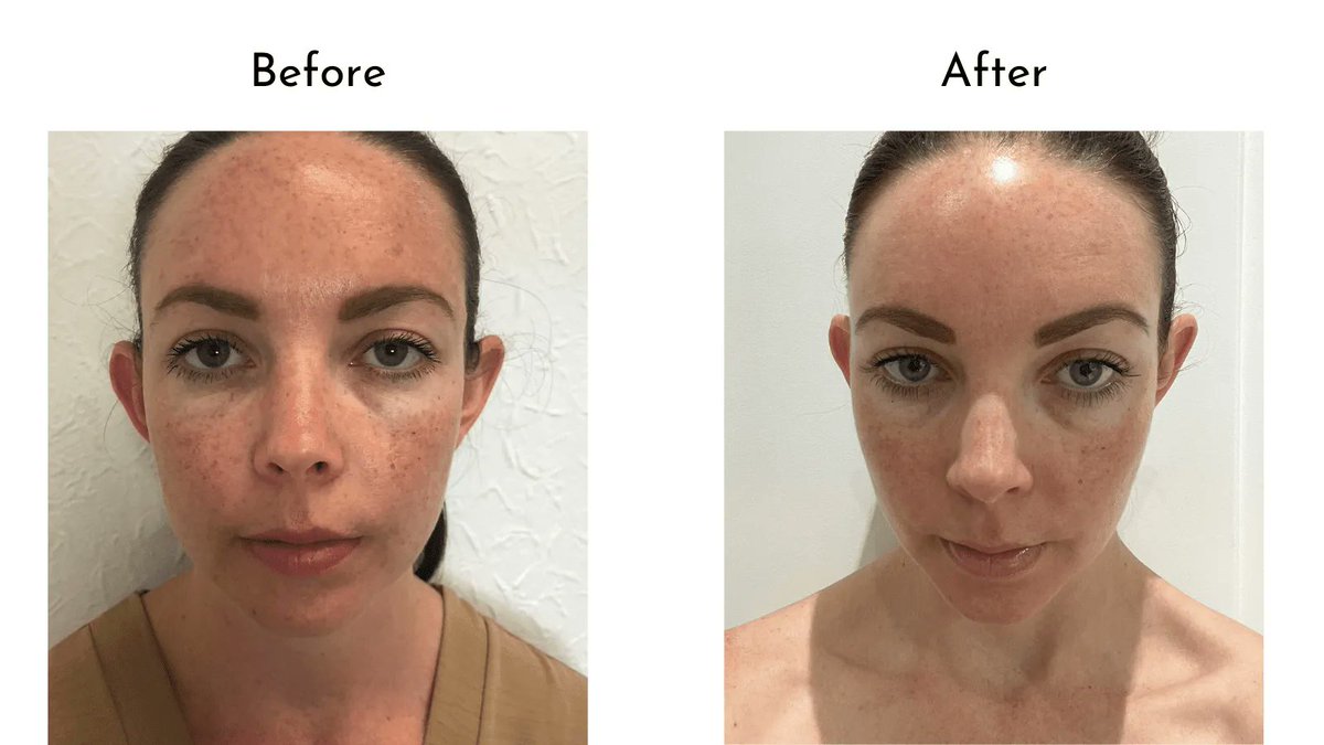 LydiaCLee (@lydiaclee) on Twitter photo On #KCACOLS this week <a href="/wander_and_luxe/">Wander & Luxe - Shelley</a> shows her month by month photos of a Hyperpigmentation treatment. buff.ly/335mrOR via @withfranca On #KCACOLS this week <a href="/wander_and_luxe/">Wander & Luxe - Shelley</a> shows her month by month photos of a Hyperpigmentation treatment. buff.ly/335mrOR via @withfranca